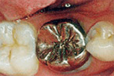 治療内容：金属を使用した治療から、ハイブリッドセラミックスクラウンを使用した治療に。
