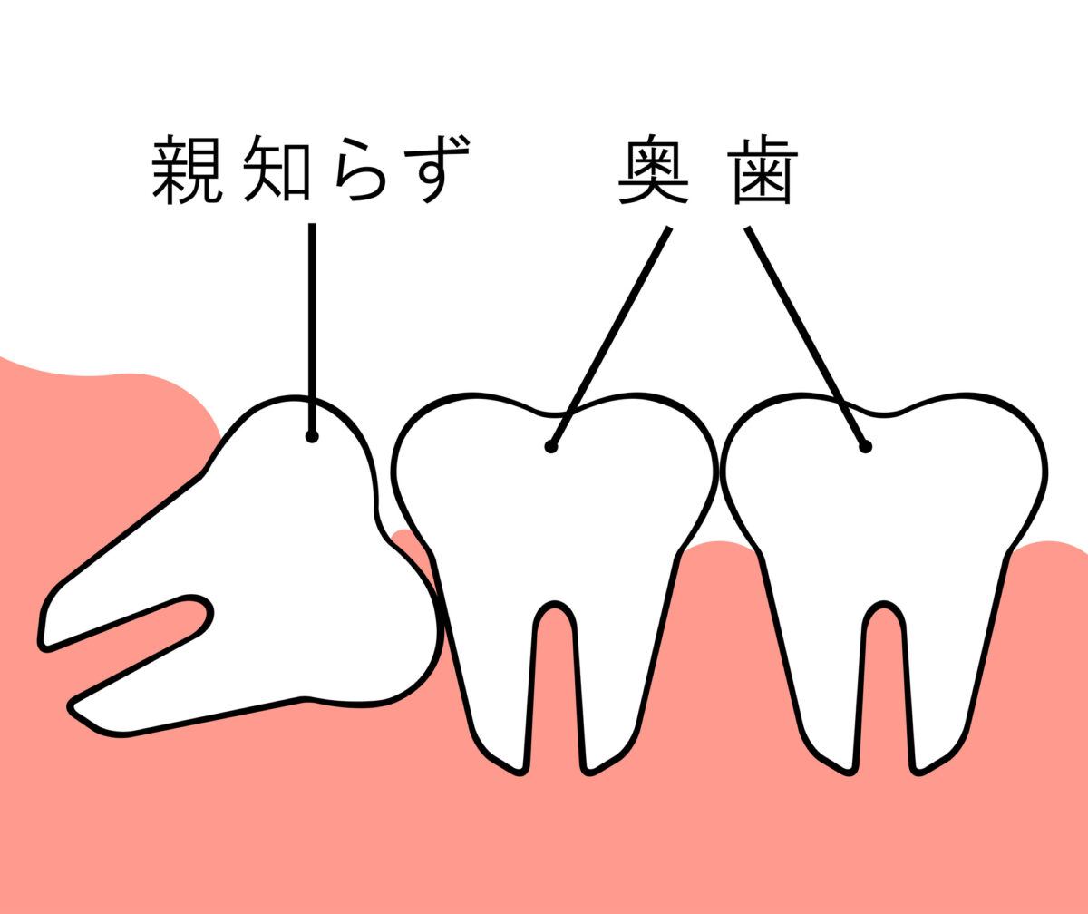親知らずとは